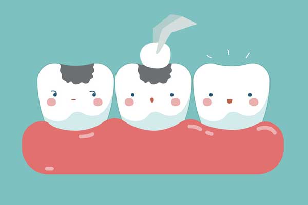 پر کردن دندان پوسیده