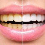 چند ترفند ساده برای سفیدی دندان