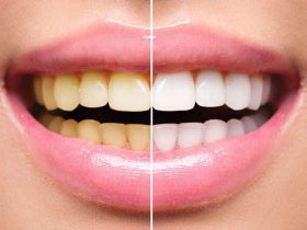 چند ترفند ساده برای سفیدی دندان